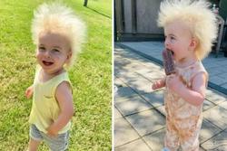 Mắc bệnh lạ, bé gái tóc bù xù giống hệt nhà khoa học Albert Einstein