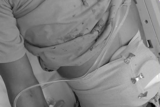 Bị đâm lòi ruột, thanh niên đi cấp cứu với cái bát tô úp trên bụng