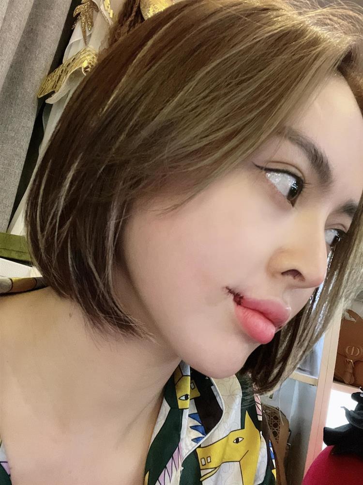 Trang Nemo tung ảnh khâu môi chằng chịt như cá chép-4