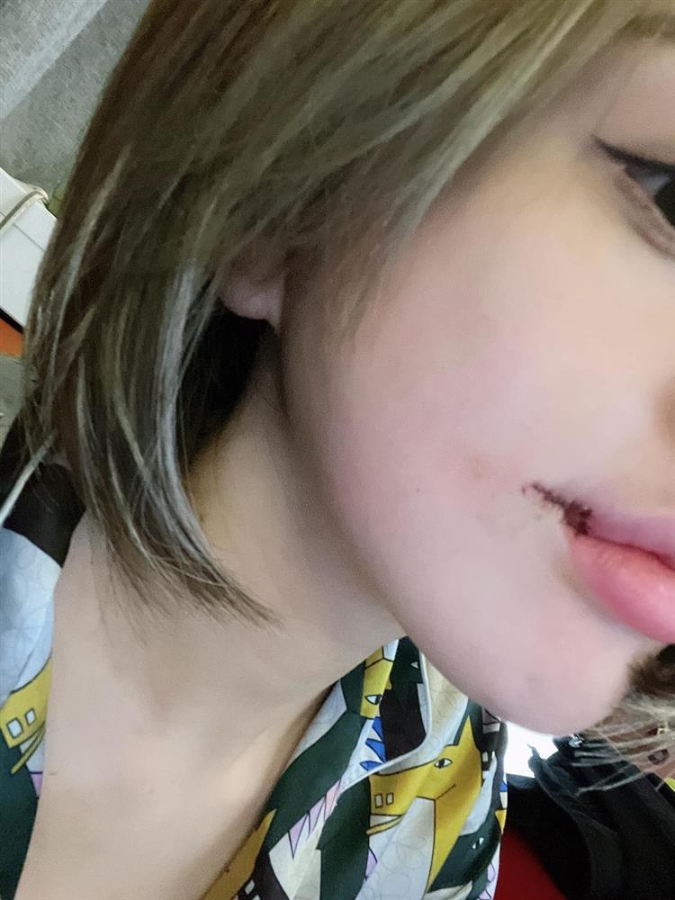 Trang Nemo tung ảnh khâu môi chằng chịt như cá chép-5