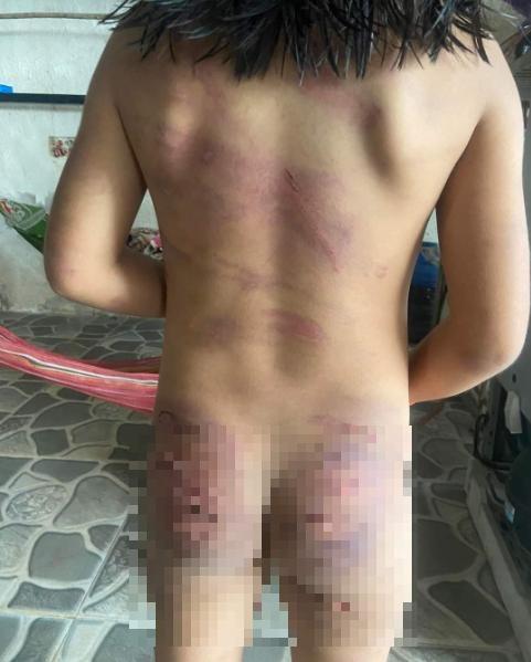 Bé gái 7 tuổi nghi bị đánh bầm tím hết người-2