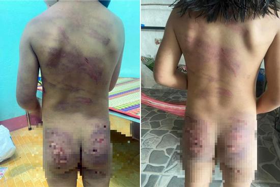 Bé gái 7 tuổi nghi bị đánh bầm tím hết người