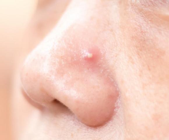 7 vị trí bị mụn này trên cơ thể cho bạn thấy sai lầm về lối sống-1