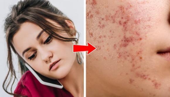 7 vị trí bị mụn này trên cơ thể cho bạn thấy sai lầm về lối sống-3