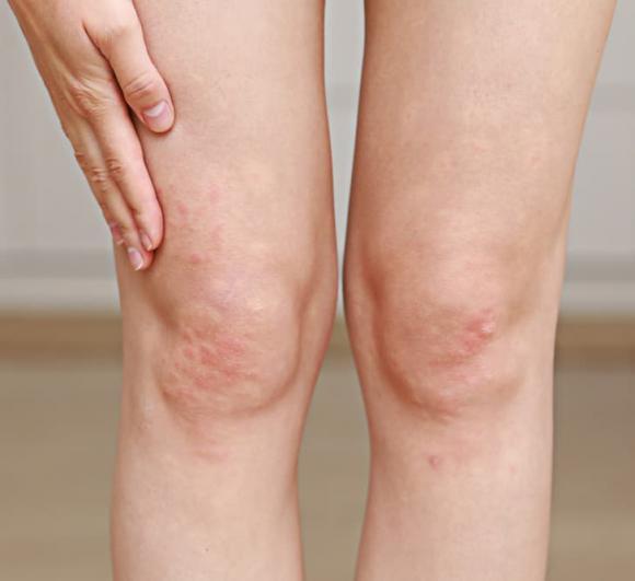 7 vị trí bị mụn này trên cơ thể cho bạn thấy sai lầm về lối sống-5