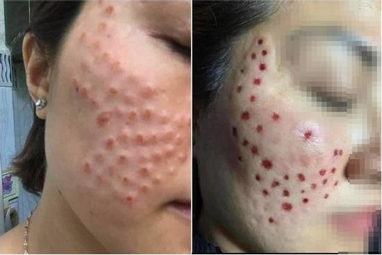 Phát hoảng với gương mặt 'tổ ong nghìn lỗ' vì tiêm da meso