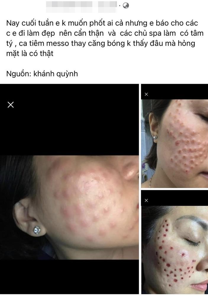 Phát hoảng với gương mặt tổ ong nghìn lỗ vì tiêm da meso-1