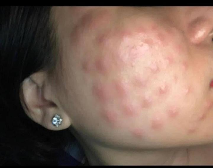 Phát hoảng với gương mặt tổ ong nghìn lỗ vì tiêm da meso-2