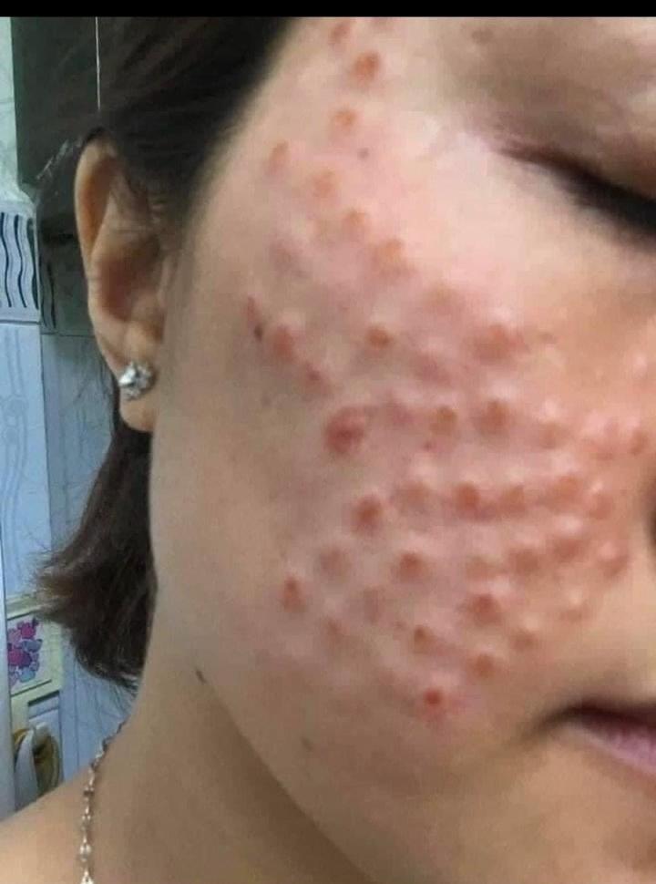 Phát hoảng với gương mặt tổ ong nghìn lỗ vì tiêm da meso-3