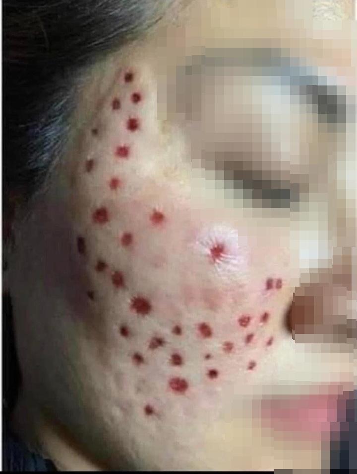 Phát hoảng với gương mặt tổ ong nghìn lỗ vì tiêm da meso-4