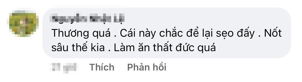 Phát hoảng với gương mặt tổ ong nghìn lỗ vì tiêm da meso-6