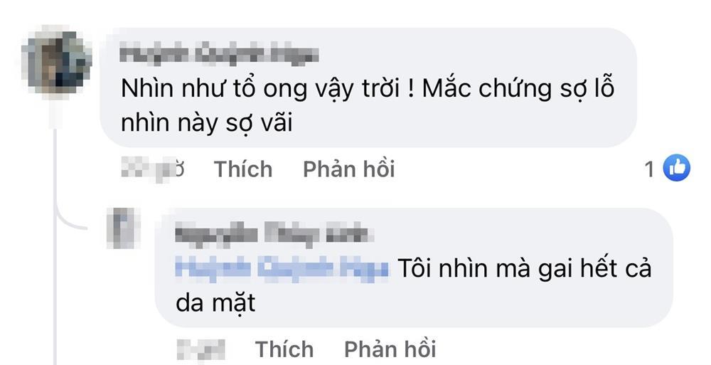 Phát hoảng với gương mặt tổ ong nghìn lỗ vì tiêm da meso-10