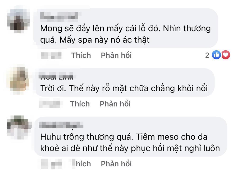 Phát hoảng với gương mặt tổ ong nghìn lỗ vì tiêm da meso-8