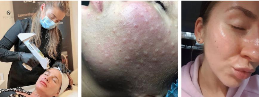 Phát hoảng với gương mặt tổ ong nghìn lỗ vì tiêm da meso-11