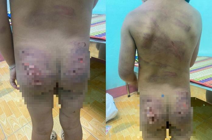 Vụ bé gái 7 tuổi nghi bị bạo hành: Công an làm việc với mẹ và cha dượng-1