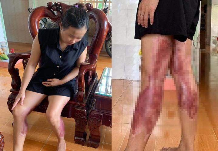 Người phụ nữ bỏng nặng 2 chân vì bị chồng cũ hành hung, tạt nước sôi-1