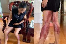 Người phụ nữ bỏng nặng 2 chân vì bị chồng cũ hành hung, tạt nước sôi