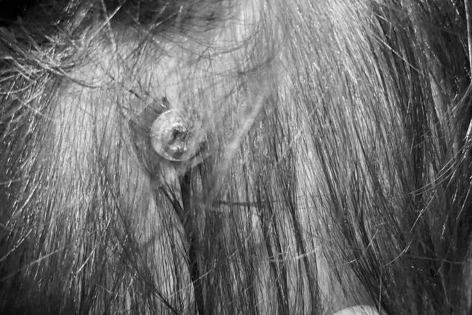 Cấp cứu kịp thời cháu bé 12 tháng tuổi bị đinh cắm vào đầu-1