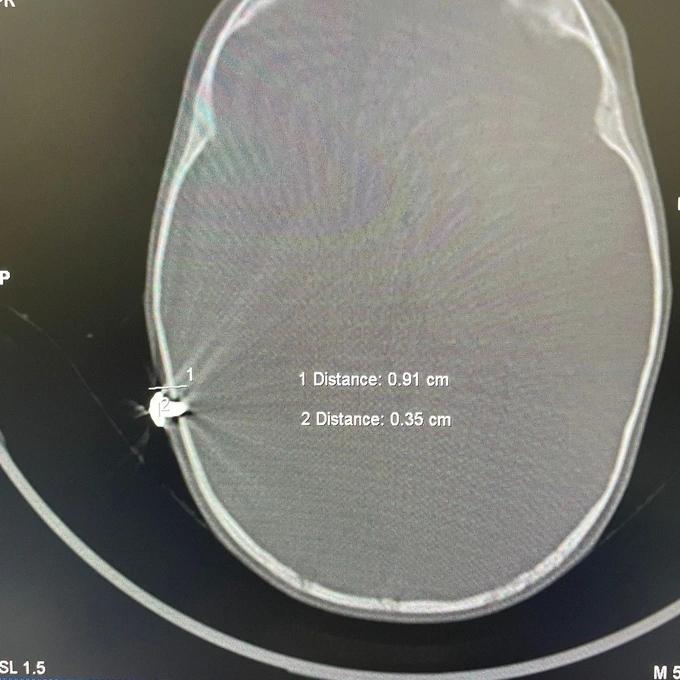 Cấp cứu kịp thời cháu bé 12 tháng tuổi bị đinh cắm vào đầu-2
