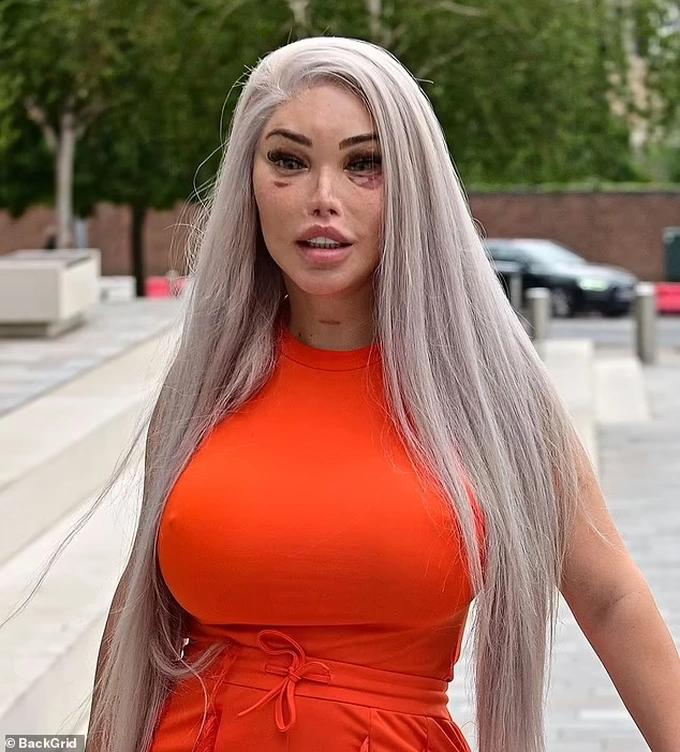 Sao chuyển giới Jessica Alves lộ diện sau ca thẩm mỹ lần thứ 90-2