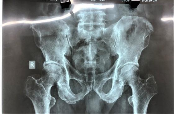 Cụ ông 70 tuổi đi cấp cứu vì nhét bí đao trong hậu môn-3