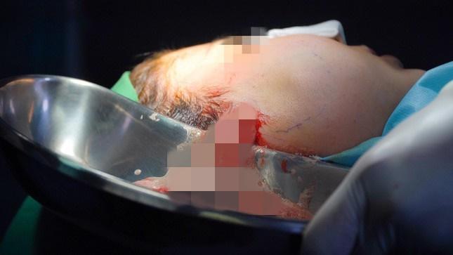 Cấp cứu thành công cô gái bị hoại tử mặt vì tiêm filler chui-2