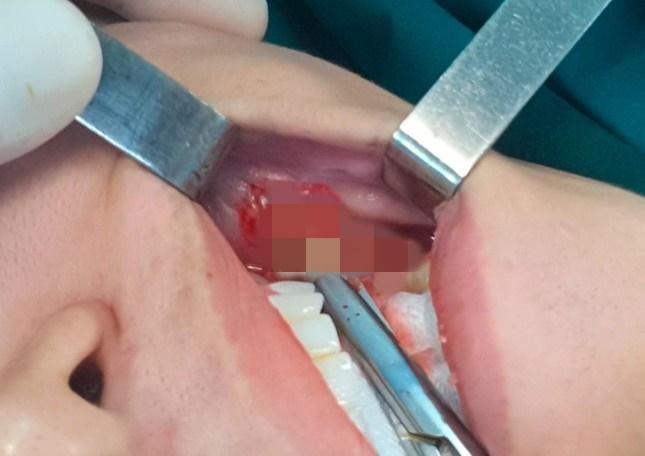 Cấp cứu thành công cô gái bị hoại tử mặt vì tiêm filler chui-3