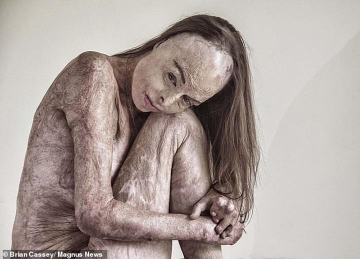 Hành trình tìm lại sự sống của cựu hoa hậu bị bỏng gần hết cơ thể-4