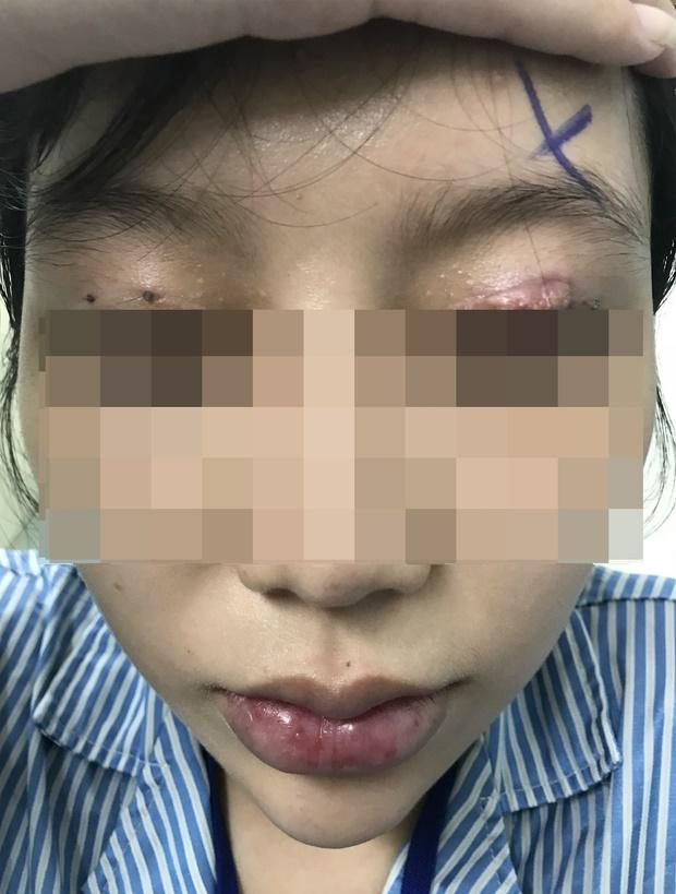 Một phụ nữ nguy cơ mù sau khi cắt mí mắt ở cơ sở thẩm mỹ chui-1