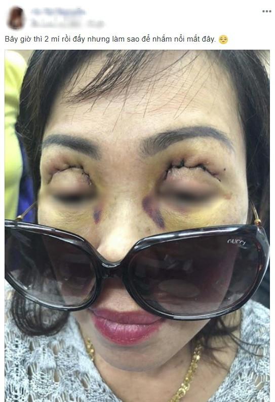 Một phụ nữ nguy cơ mù sau khi cắt mí mắt ở cơ sở thẩm mỹ chui-3