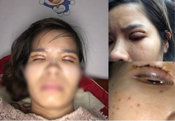 Một phụ nữ nguy cơ mù sau khi cắt mí mắt ở cơ sở thẩm mỹ chui-4