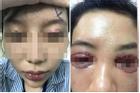 Một phụ nữ nguy cơ mù sau khi cắt mí mắt ở cơ sở thẩm mỹ 'chui'