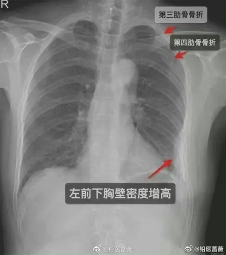 Cô gái bị nam đồng nghiệp ôm đến gãy xương sườn-1