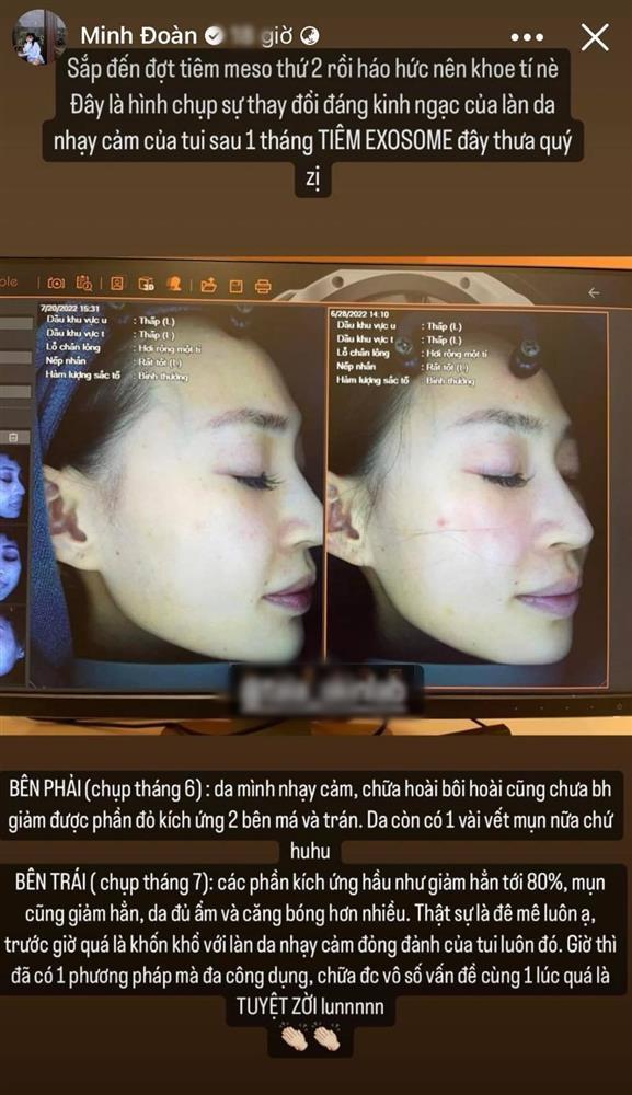 Bất chấp có thể bị biến chứng, một hot girl liều mình tiêm meso-2