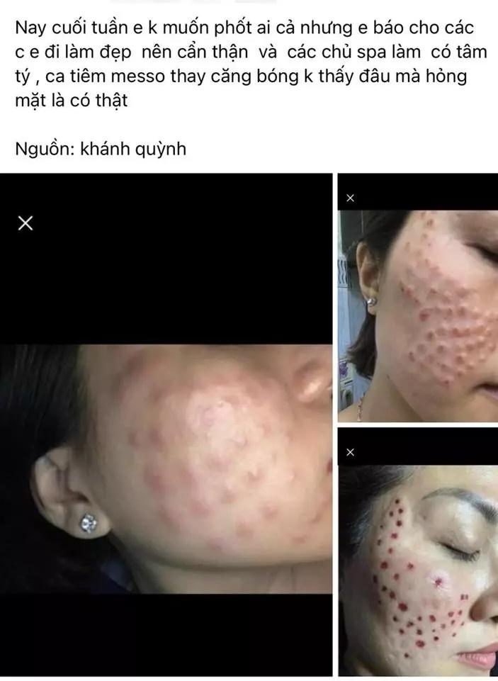 Bất chấp có thể bị biến chứng, một hot girl liều mình tiêm meso-3