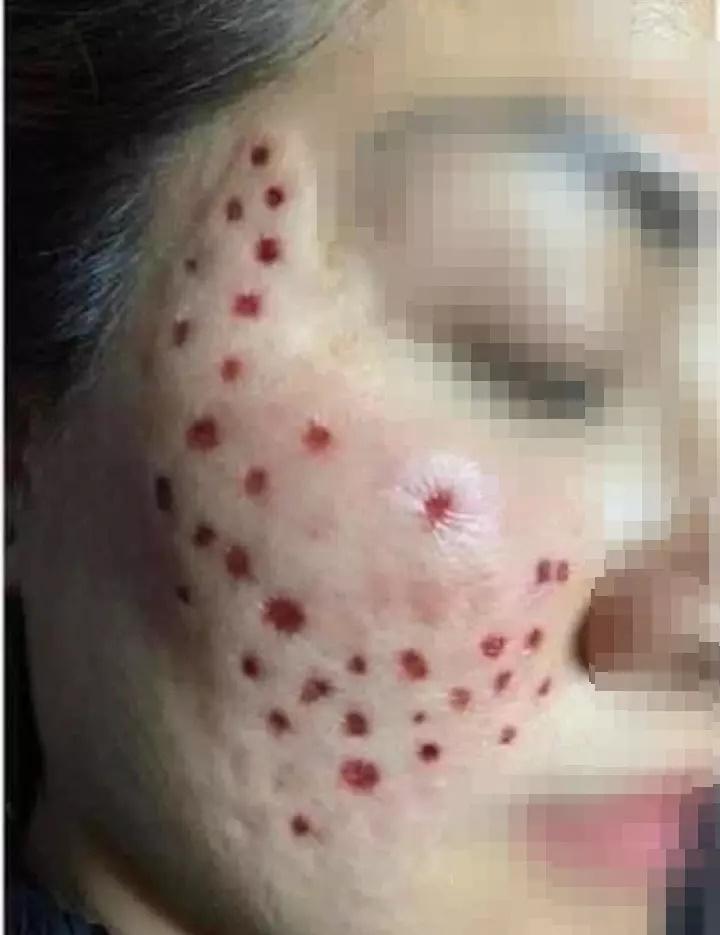 Bất chấp có thể bị biến chứng, một hot girl liều mình tiêm meso-4