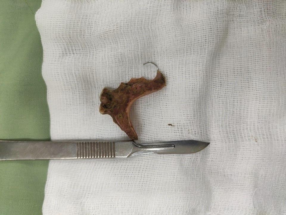 Nuốt nhầm hàm răng giả, cụ bà suýt tử vong vì thủng đại tràng-1