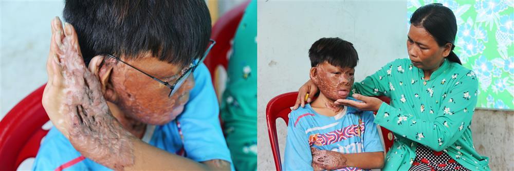 Vu Lan buồn của cậu bé bị bỏng 96%: Mẹ không còn, con nhớ nhiều lắm-1