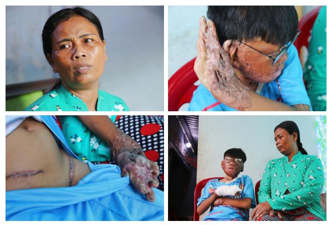 Vu Lan buồn của cậu bé bị bỏng 96%: Mẹ không còn, con nhớ nhiều lắm-3