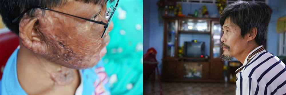 Vu Lan buồn của cậu bé bị bỏng 96%: Mẹ không còn, con nhớ nhiều lắm-5