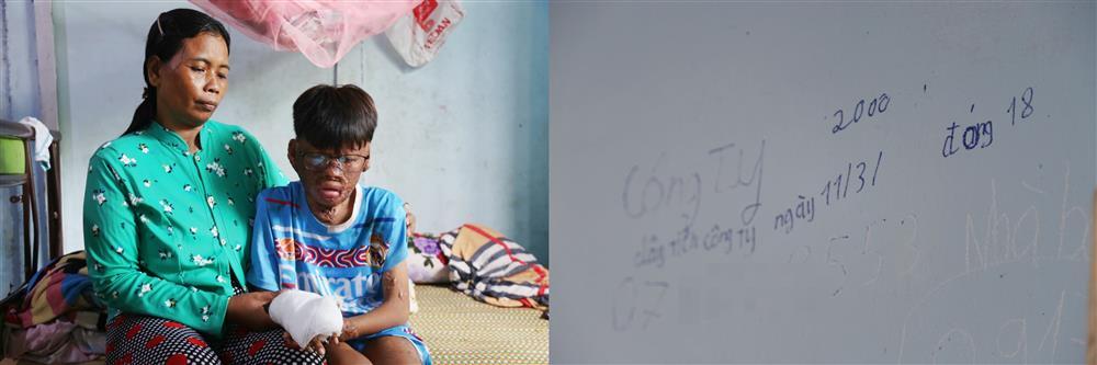 Vu Lan buồn của cậu bé bị bỏng 96%: Mẹ không còn, con nhớ nhiều lắm-9