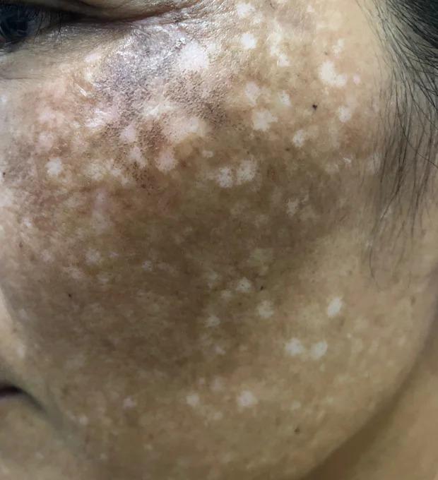 Nhiễm độc corticoid, da mỏng tang sau khi bôi kem trộn chữa nám-2