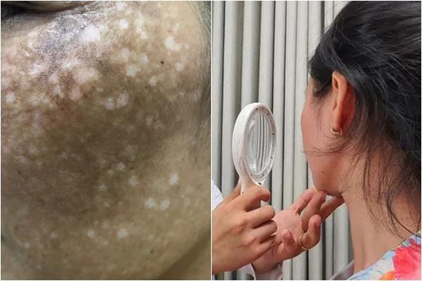 Cảnh báo cách trị nám bằng kem bôi có chất làm trắng huỳnh quang-3