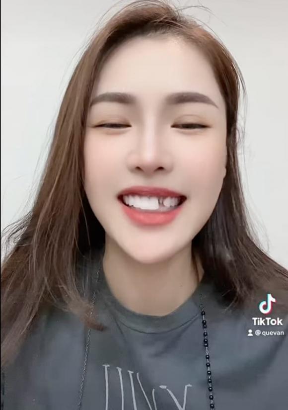 Quế Vân rụng răng sứ trông dở khóc dở cười-1