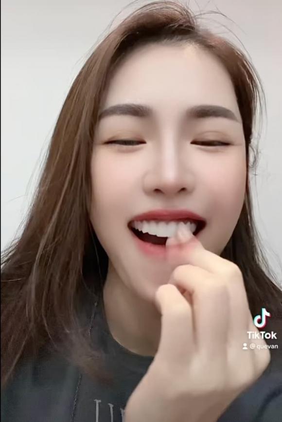 Quế Vân rụng răng sứ trông dở khóc dở cười-4