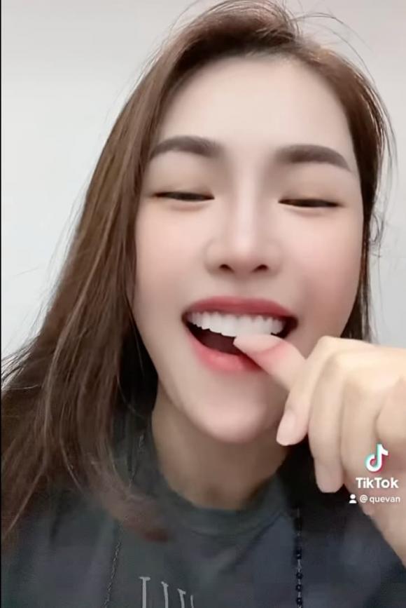 Quế Vân rụng răng sứ trông dở khóc dở cười-5