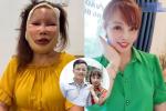 Tá hỏa mặt tiền cô dâu Cao Bằng sau 2 năm biến chứng thẩm mỹ