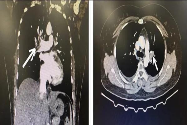 Người phụ nữ suýt tử vong chỉ vì ưa uống viên tránh thai khẩn cấp-1