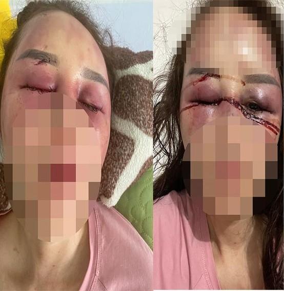 Người phụ nữ tố cáo bạn trai đánh gãy hàm, dập mũi, chảy máu mắt-1