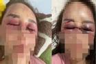 Người phụ nữ tố cáo bạn trai đánh gãy hàm, dập mũi, chảy máu mắt